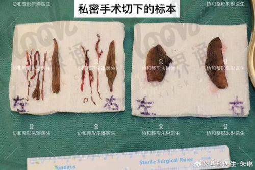 阴道松弛做八爪鱼紧致修复手术多少钱呀？看2025年收费价格表你就心中有数了