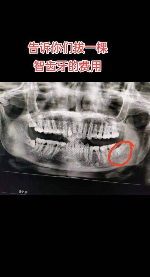上海青浦拔牙价格区间一览表