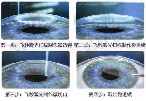 总结：重庆近视眼手术，大致多少钱应该这样理解