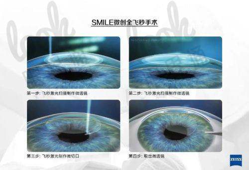从术前检测角度看近视手术费用的“起点”