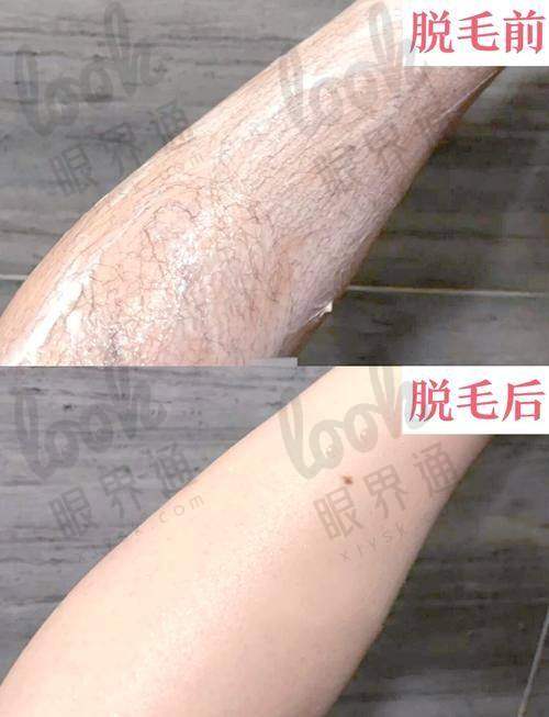 西安激光脱毛排名前十医院榜单一览
