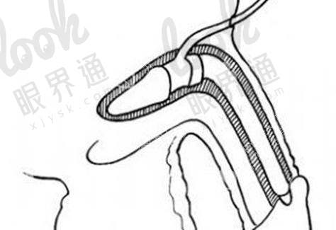 2025玻尿酸增大增粗手术多少钱？这有一份收费价格表可以提供给你查询
