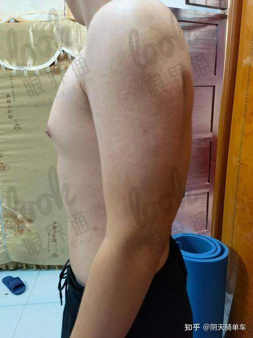 腹肌整形细分方案——从吸脂到个性线条塑造