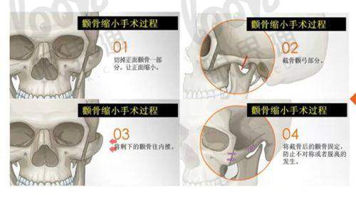 重庆肖林做下颌角手术成效怎么样？脸会垂吗？