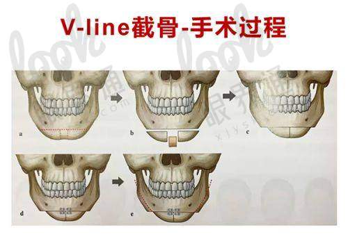 那么，重庆松山下颌角整形为何这么受欢迎？幕后医院实力揭秘