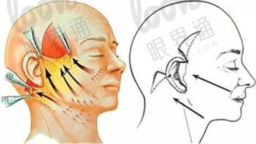 肖林医生的磨骨技术优势