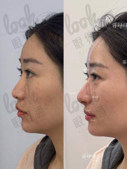 广州郭栋做鼻子怎么样？是北京蒂凡妮整形的院长隆鼻技术稳定审美高