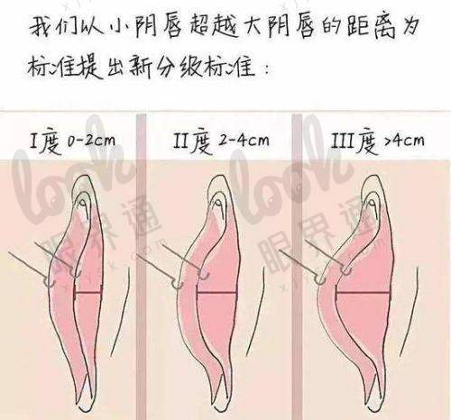 整体私密手术的特色与益处