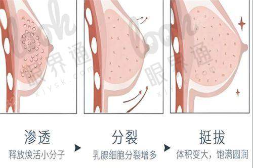 曾昂医生隆胸手术口碑如何？