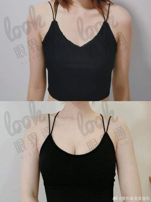 隆胸后能哺乳吗？曾昂医生手术能保功能？