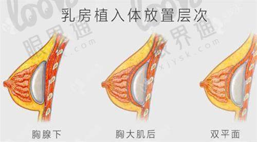 四、八大处假体隆胸是否值得做？从术后反馈看真相