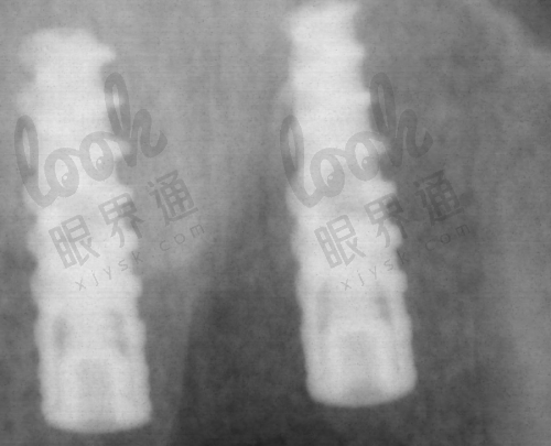 技术亮点一：舒适化微痛种植+微创技术