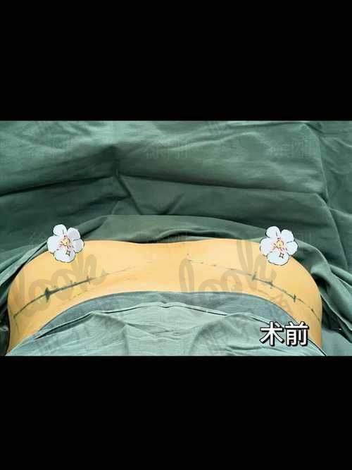 五、八大处隆胸术式选择多，到底适合你哪种？