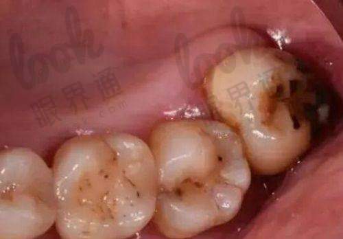 拔牙价格情况